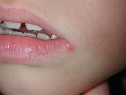 Lip with a cold sore on the bottom left side with the bumps on the lip as well.