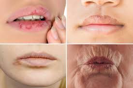 Four lips with different conditions. One with herpes, one with chap lips, one with old line and one with lack of hydration.