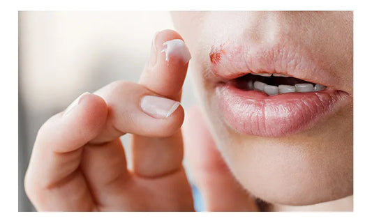 Lip with herpes and putting cream on it