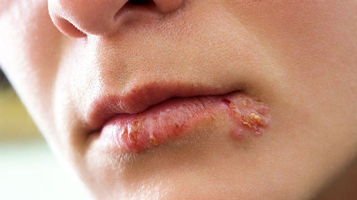 Lip with showing herpes at the lower left lip. 