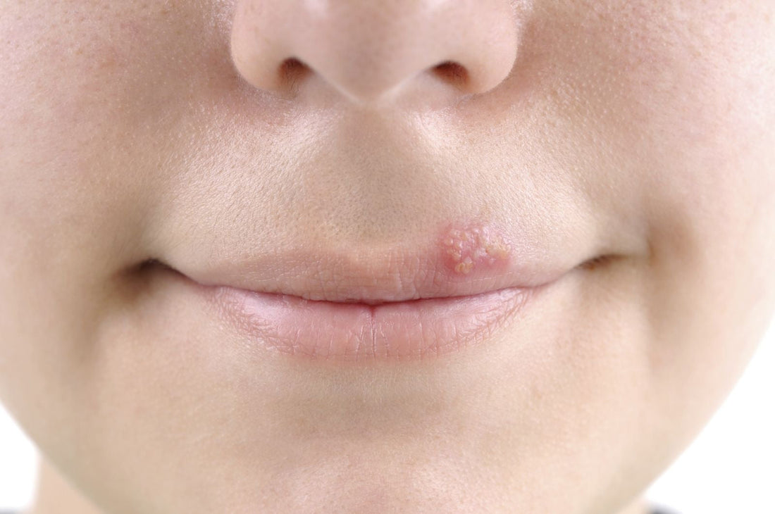 Lip with herpes