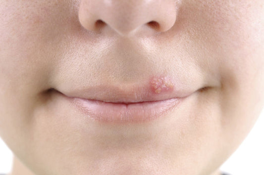 Lip with herpes